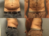 Vaser Liposuction