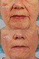 Wrinkle Treatment