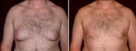 29 Year Old Male, male breast reduction