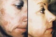 Chemical Peel 