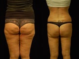 Cellulaze and Smartlipo Eleven Month Follow Up