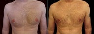31 year old male, male breast reduction