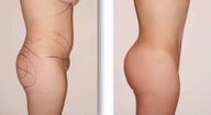Liposuction and lipoinjection