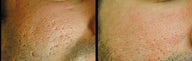 CO2 Laser
