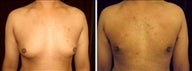 30 year old male, male breast reduction