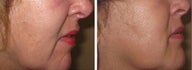Juvederm/Fat Grafting