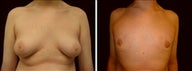 15 year old male, male breast reduction