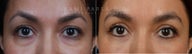 Before and After upper and lower eyelid blepharoplasty