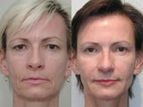 Eyelid Surgery