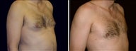 40 year old male, male breast reduction