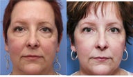 51 year old female treated for lower eyelid aging