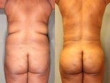 33 Year Old Female  FAT TRANSFER to Buttocks