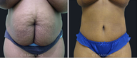 Tummy Tuck