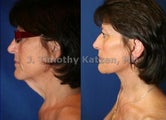 Neck Lift