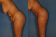 Tummy Tuck