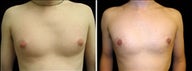 25 year old male, male breast reduction