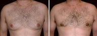 24 year old male, male breast reduction