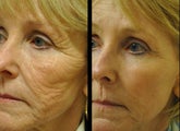 After one CO2 laser treatment on full face.