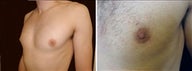 24 year old male, male breast reduction