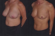 Breast Reduction