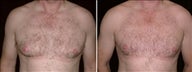 43 year old male, male breast reduction