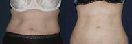 Liposuction