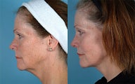 Facelift