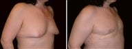 46 year old male, male breast reduction