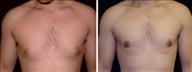 20 year old male, male breast reduction