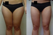 Liposuction Thighs (inner and outer)
