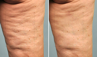 Cellulaze