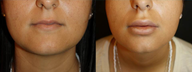 Two weeks after a dermal fat graft to both upper and lower lips.