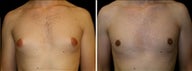 25 year old male, male breast reduction