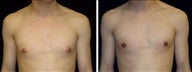 33 year old male, male breast reduction