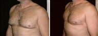 38 year old male, male breast reduction