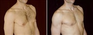 38 year old male, male breast reduction