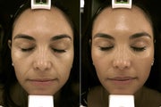 38 year old woman treated with Restylane for infraorbital hollows and nasolabial folds