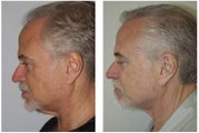 Neck Lift