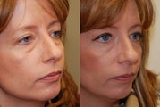 Lower eyelid rejuvenation with Silikon-1000