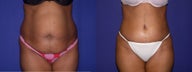 Tummy Tuck