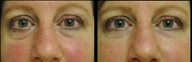 Juvederm and Belotero