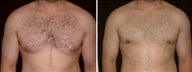 30 year old male, male breast reduction