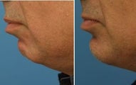 Chin implant to correct facial features