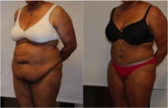 Large Abdominoplasty 3 months before and after