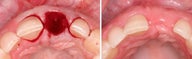 Extraction and Graft