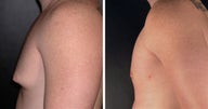 Gynecomastia 