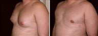 40 year old male, male breast reduction