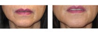Juvederm/Fat Grafting