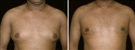 26 year old male, male breast reduction