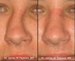 Rhinoplasty